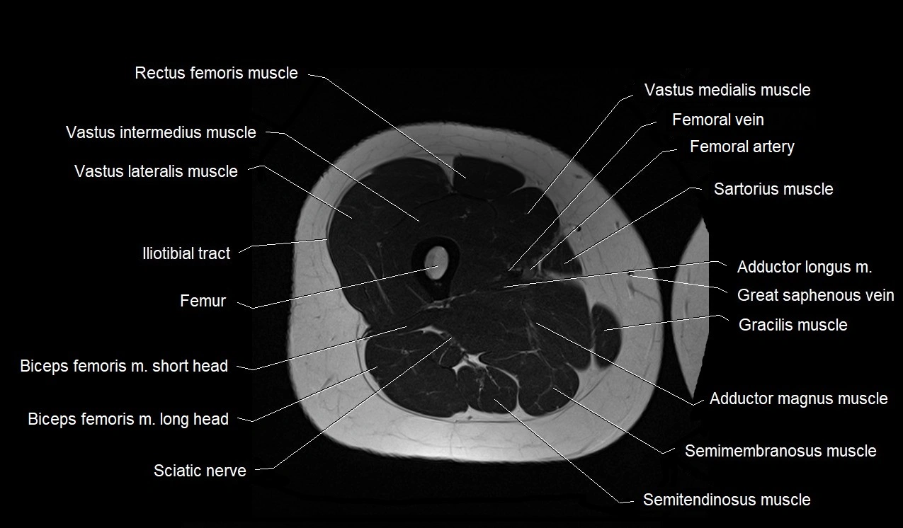 MRI thigh cross sectional anatomy image 33.webp